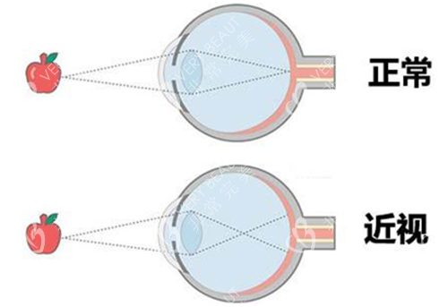 正常眼睛和近视眼看东西的区别