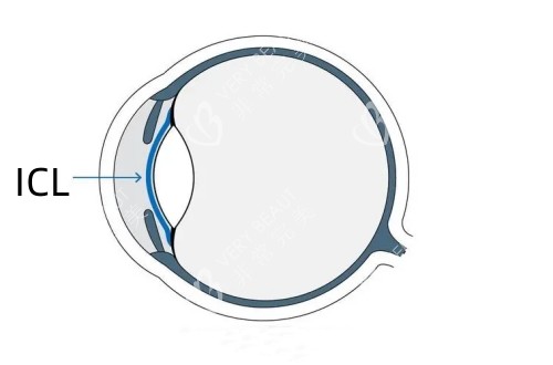 ICL在眼睛里的位置侧面卡通照片