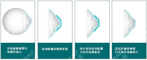 角膜塑形镜的矫正过程