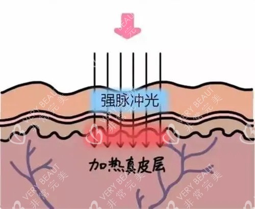 光子嫩肤的针对的皮肤层