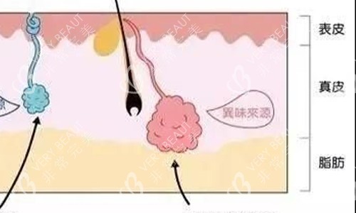 狐臭皮下示意图