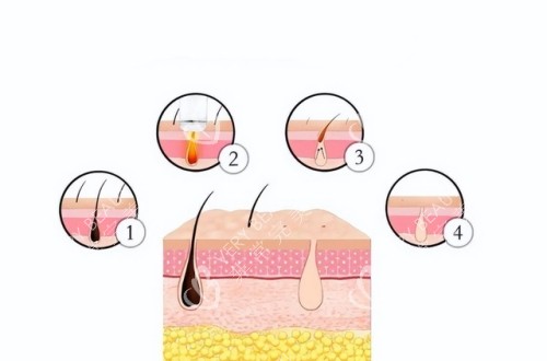 激光脱毛后的毛发变化前后对比图