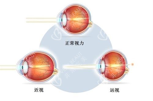 正常眼近视眼远视眼示意图