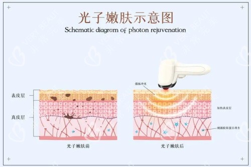 光子嫩肤的示意图