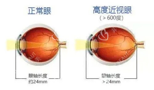 正常眼和高度近视眼示意图