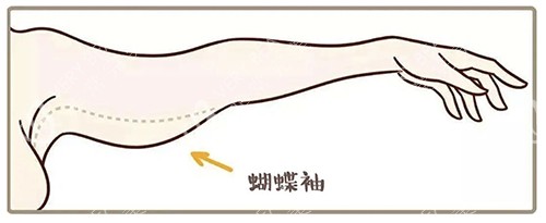 北京华韩整形手臂术前示意图
