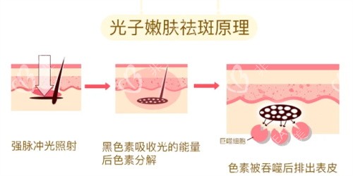 光子嫩肤的祛斑原理