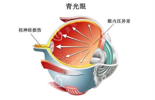 青光眼眼部形态示意图