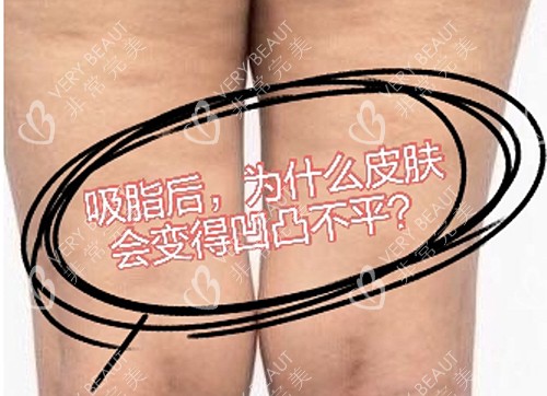 吸脂后凹凸不平问题