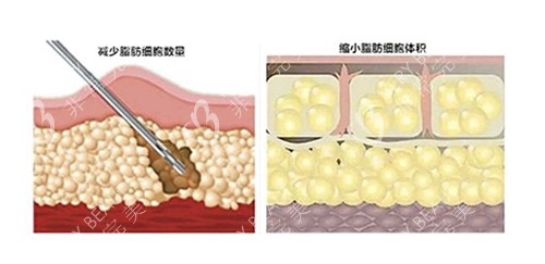 北京华韩吸脂过程卡通图