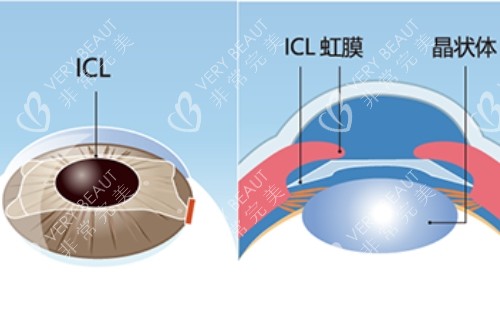 ICL晶体在眼睛里面的具体位置卡通示意图