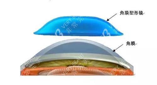 角膜塑形镜示意图