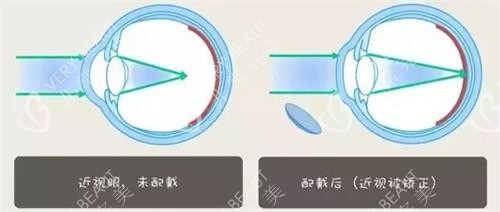 近视眼佩戴角膜塑形镜之后的改变