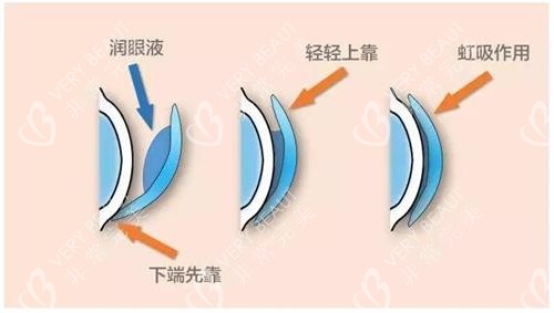 角膜塑形镜的佩戴方法