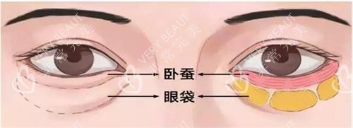 眼袋和卧蚕的区别