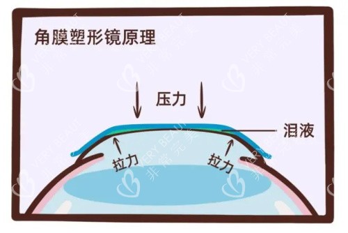 角膜塑形镜的原理