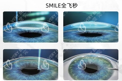 SMILE全飞秒手术具体过程示意图