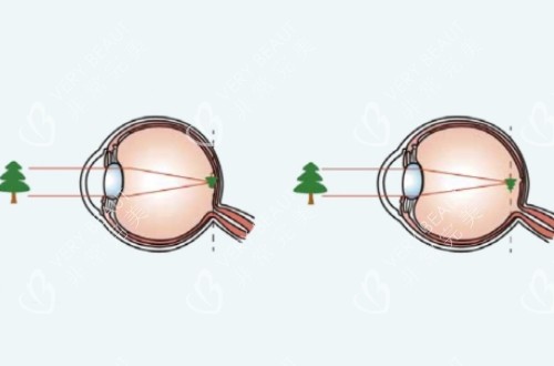 正常视力与近视视力的成像对比图