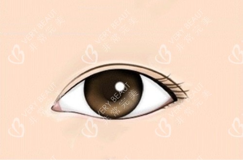 做完开眼角手术的内眼角卡通示意图