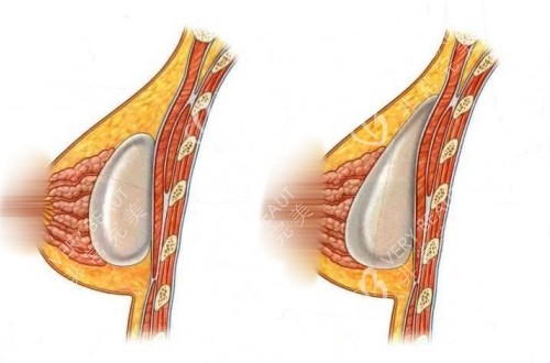 圆形假体和水滴形假体隆胸的对比照片