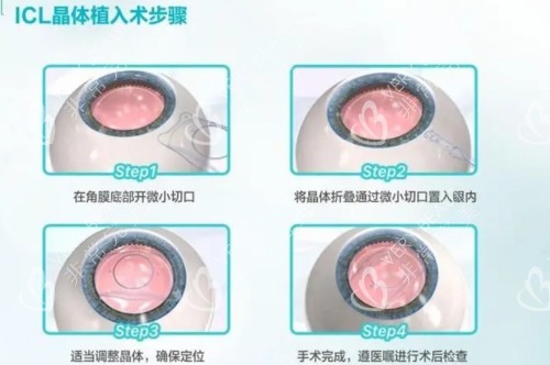 ICL晶體植入手術(shù)步驟圖