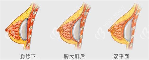 假体隆胸手术假体的植入的层次不同