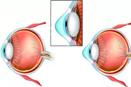 圆锥角膜的眼球解剖卡通示意图