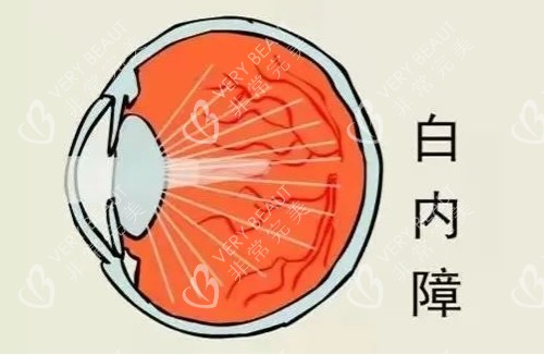 白内障原理图