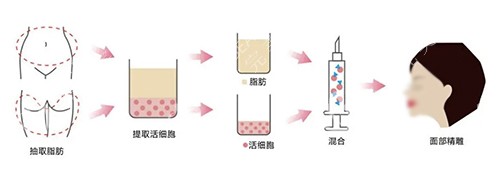 面部自体脂肪填充过程