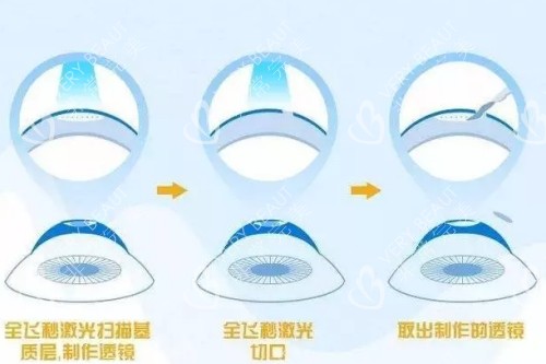 全飞秒手术示意图