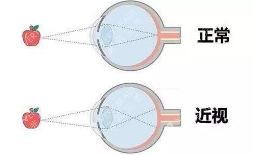 正常眼与白内障对比