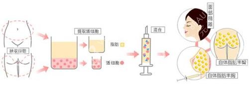 自体脂肪丰胸的手术步骤