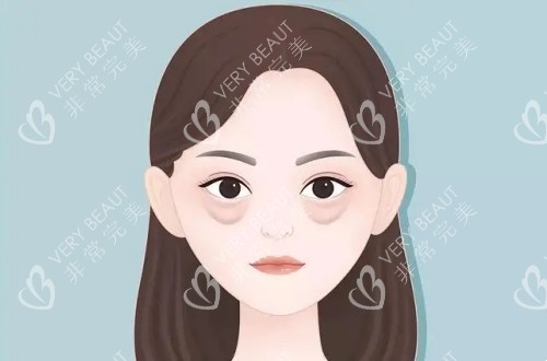 类似三角形的眼袋卡通示意图