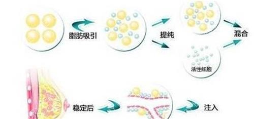 自体脂肪丰胸的填充方法