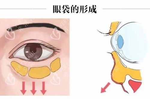 眼袋的形成部分过程示意图