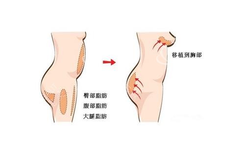 自体脂肪丰胸的原理