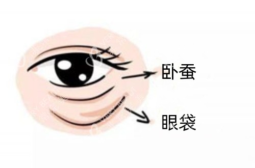 卧蚕和眼袋在眼下位置的卡通示意图