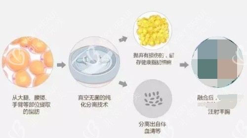 自体脂肪丰胸的吸出脂肪的过程