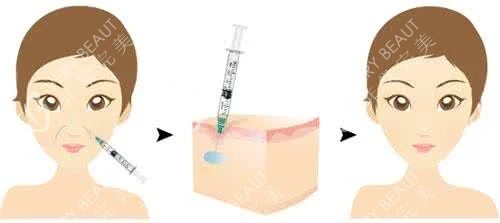 玻尿酸填充法令纹的过程