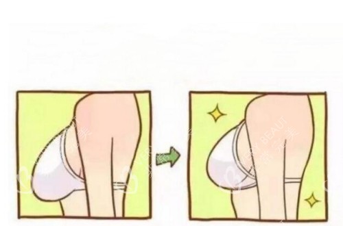 胸部下垂和胸部挺拔的前后对比图