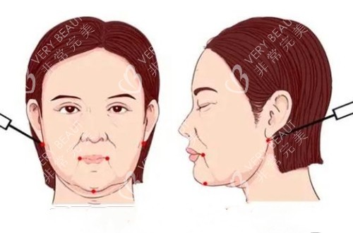 面部吸脂的卡通示意图