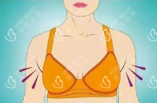 穿上胸罩后勒出的副乳卡通示意图