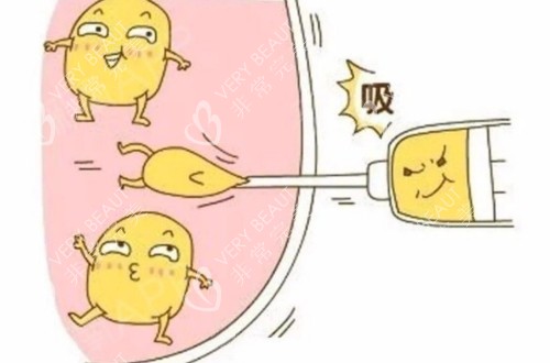 吸脂过程的卡通示意图