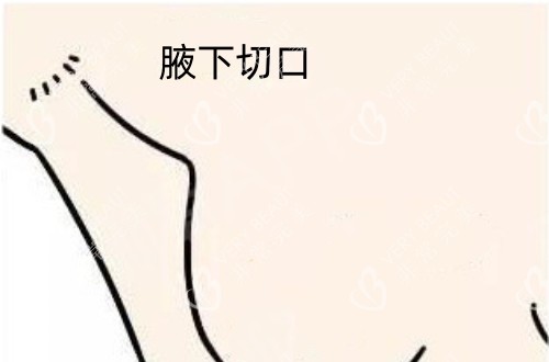 假体隆胸腋下切口示意图