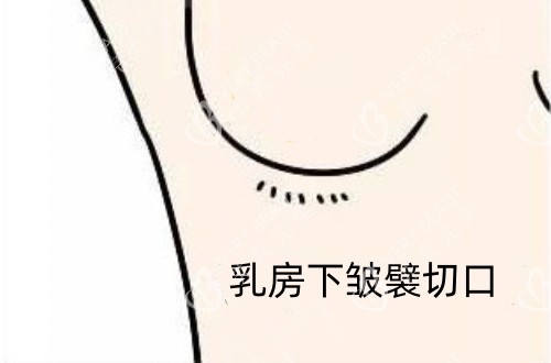 假体隆胸乳房下皱襞切口示意图