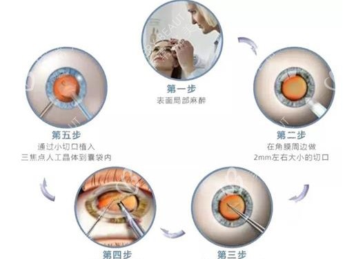 人工晶体植入手术过程