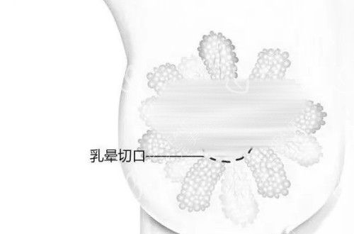 假体隆胸乳晕切口示意图