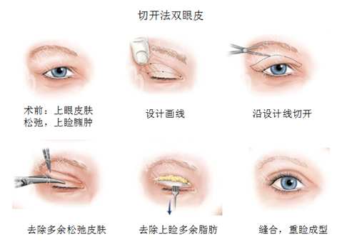 全切双眼皮手术过程