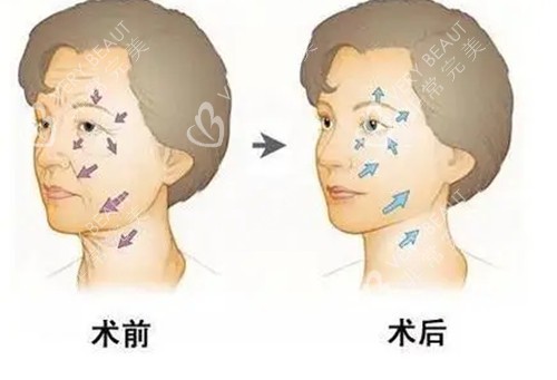 面部抗衰提升前后对比示意图