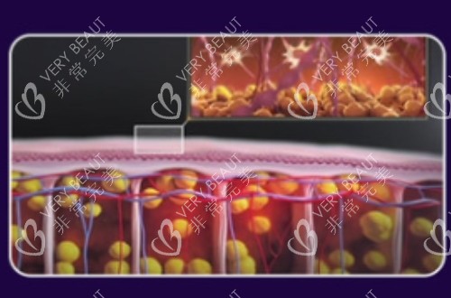 5G天使光雕吸脂后脂肪结构保存完整的示意图